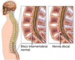 hernia de disco