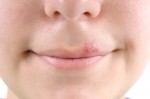herpes-labial-tratamentos-para-esta-doenca